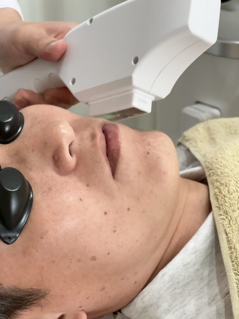 D'REXでの男性ヒゲ脱毛