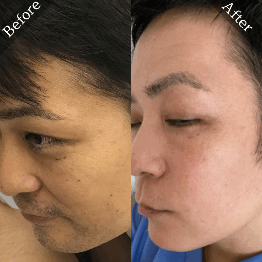 ヒゲ脱毛のビフォ－アフター