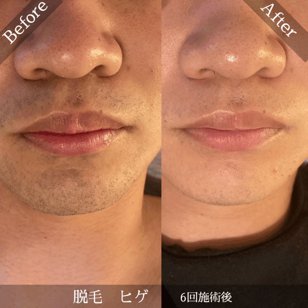 ヒゲ脱毛ビフォーアフター