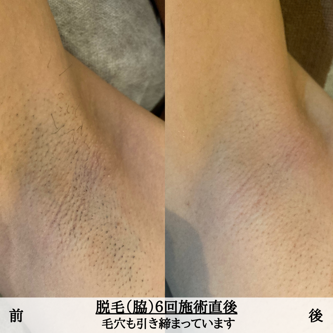 わき脱毛